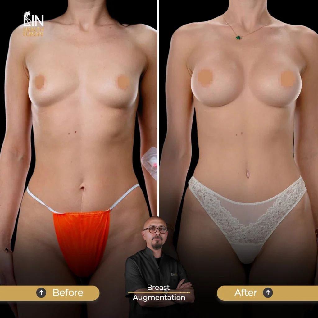 Breast-A-3