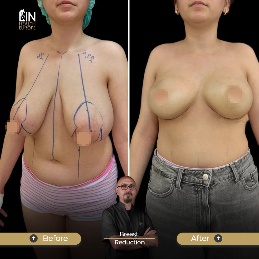 Breast-R-2