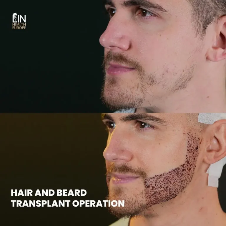 lin-beard-transplant-before-after
