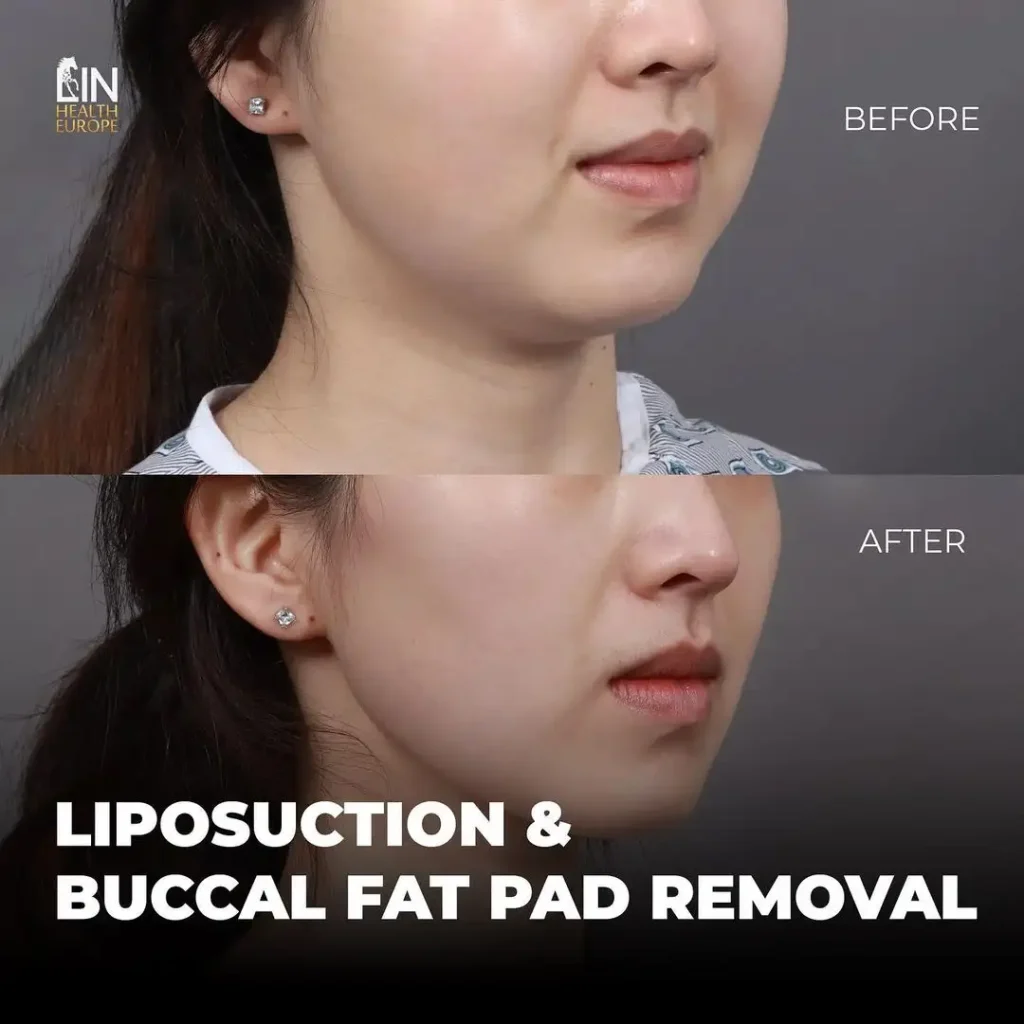 lin-liposuction-before-after