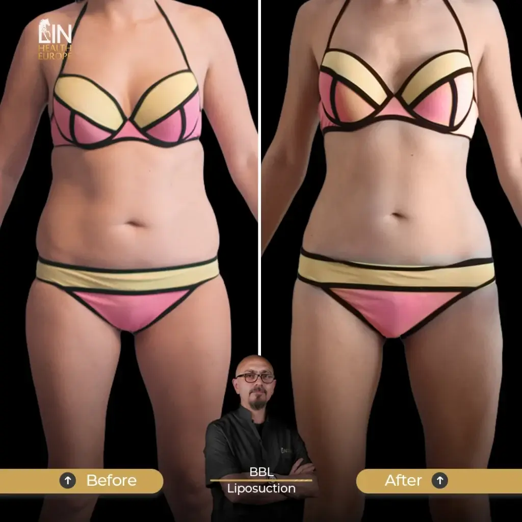 Lipo