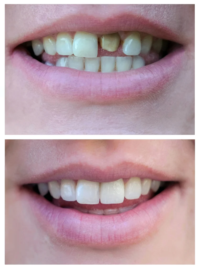 implant-before-after-2