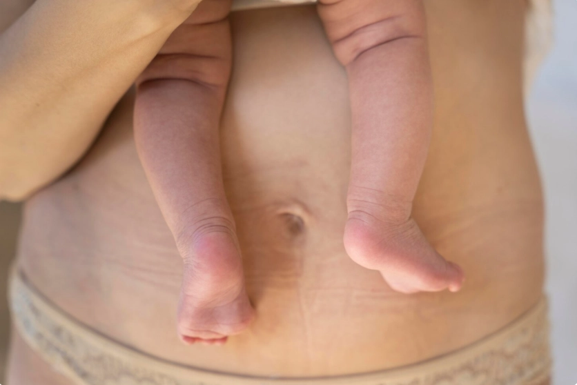 ліпо after pregnancy