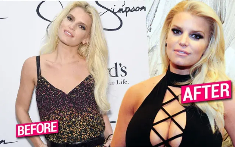 jessica simpson înainte și după implanturi mamare