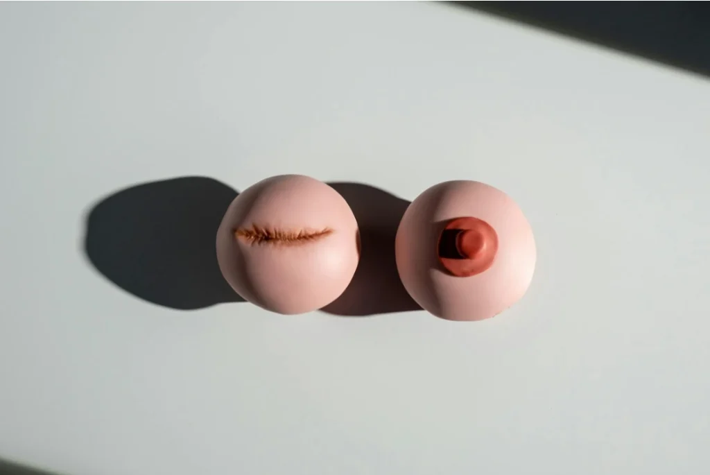 mastectomy surgery