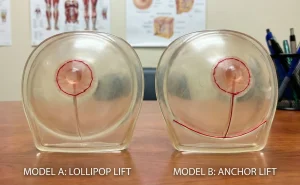 anatomical breast models lollipop vs anchor scars