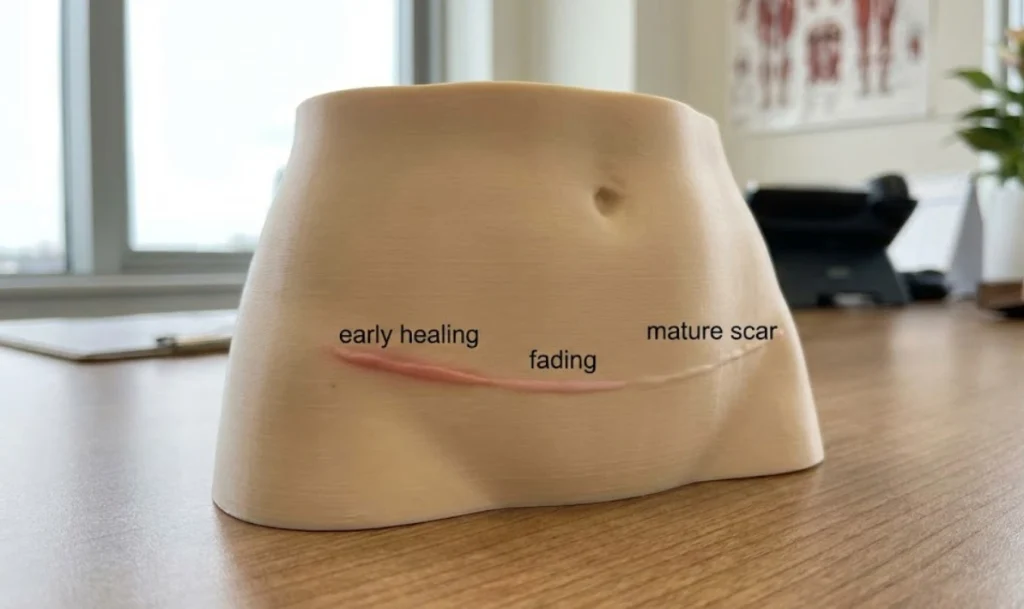 applying scar cream after tummy tuck surgery