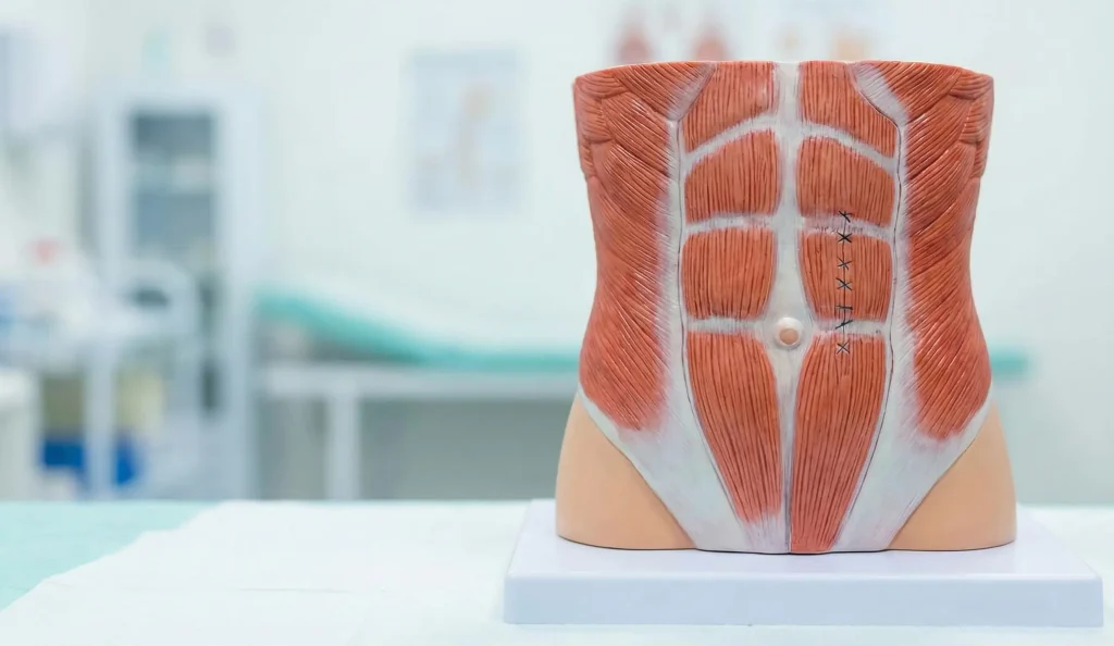 Anatomisches Modell, das den diastasis recti-Repair zeigt