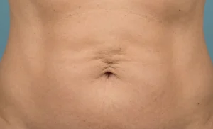 long term liposuction result affected by natural aging and skin laxity