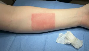rectangular tape reaction redness