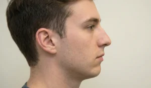 side profile recessed chin male