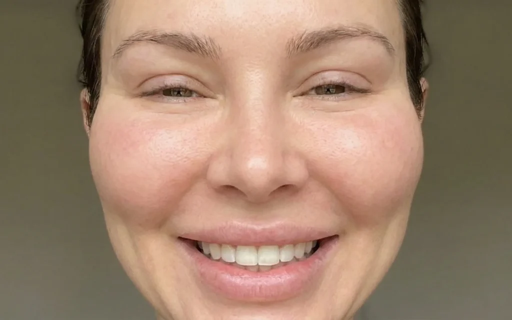 woman smiling excessive cheek filler pillow face effect