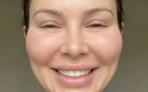 woman smiling excessive cheek filler pillow face effect