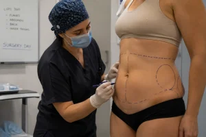 liposuction surgery day