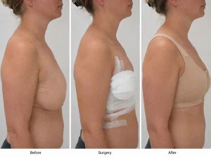breast lift before surgery after comparison