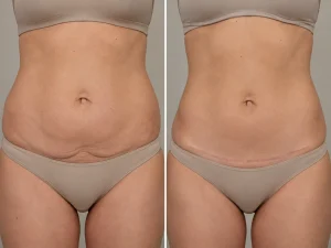 how does a tummy tuck change your body before and after