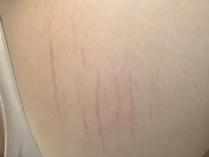 stretch marks after breast augmentation close up