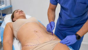 tummy tuck procedure before the surgery